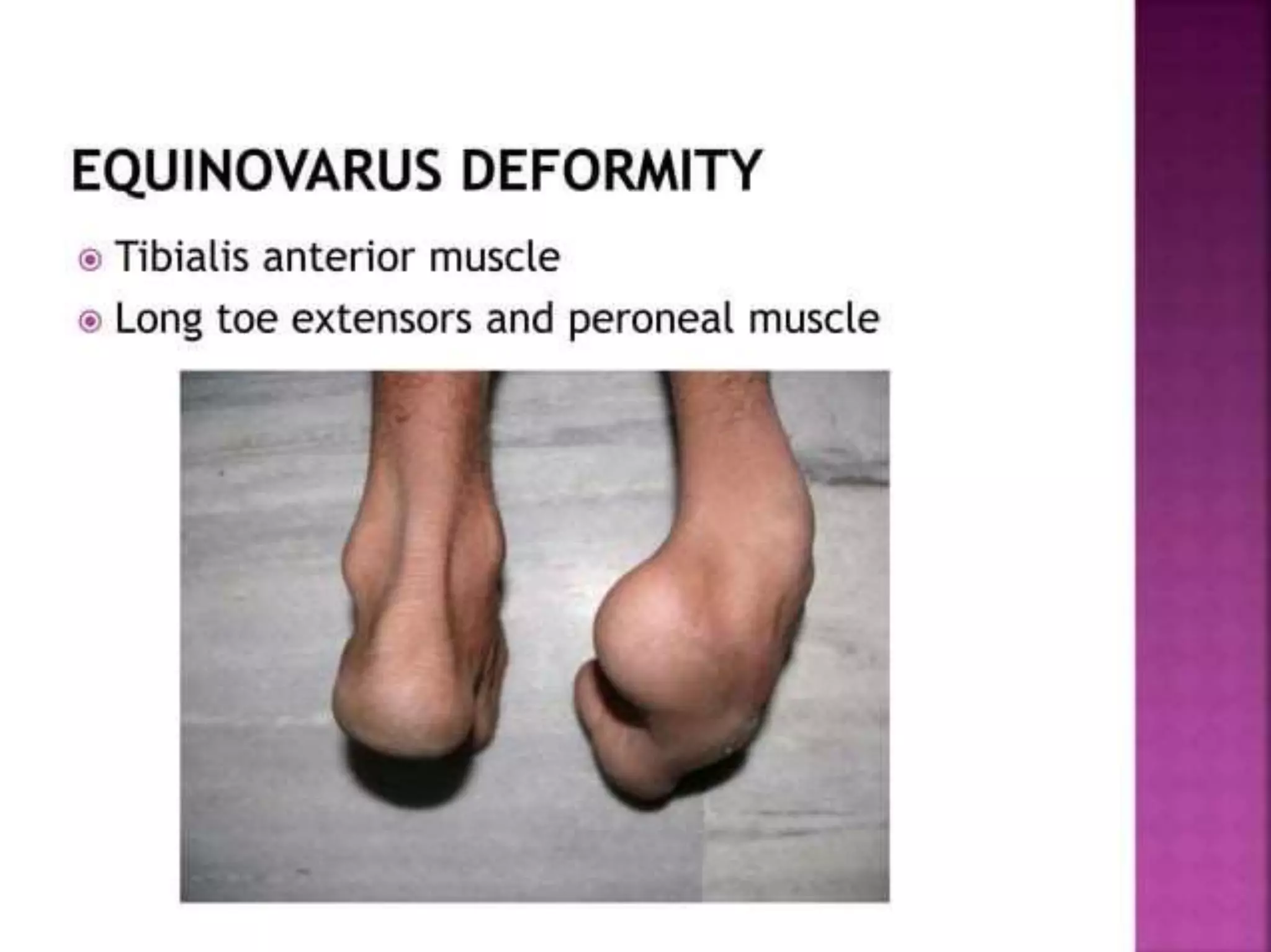 post polio residual paralysis.pptx