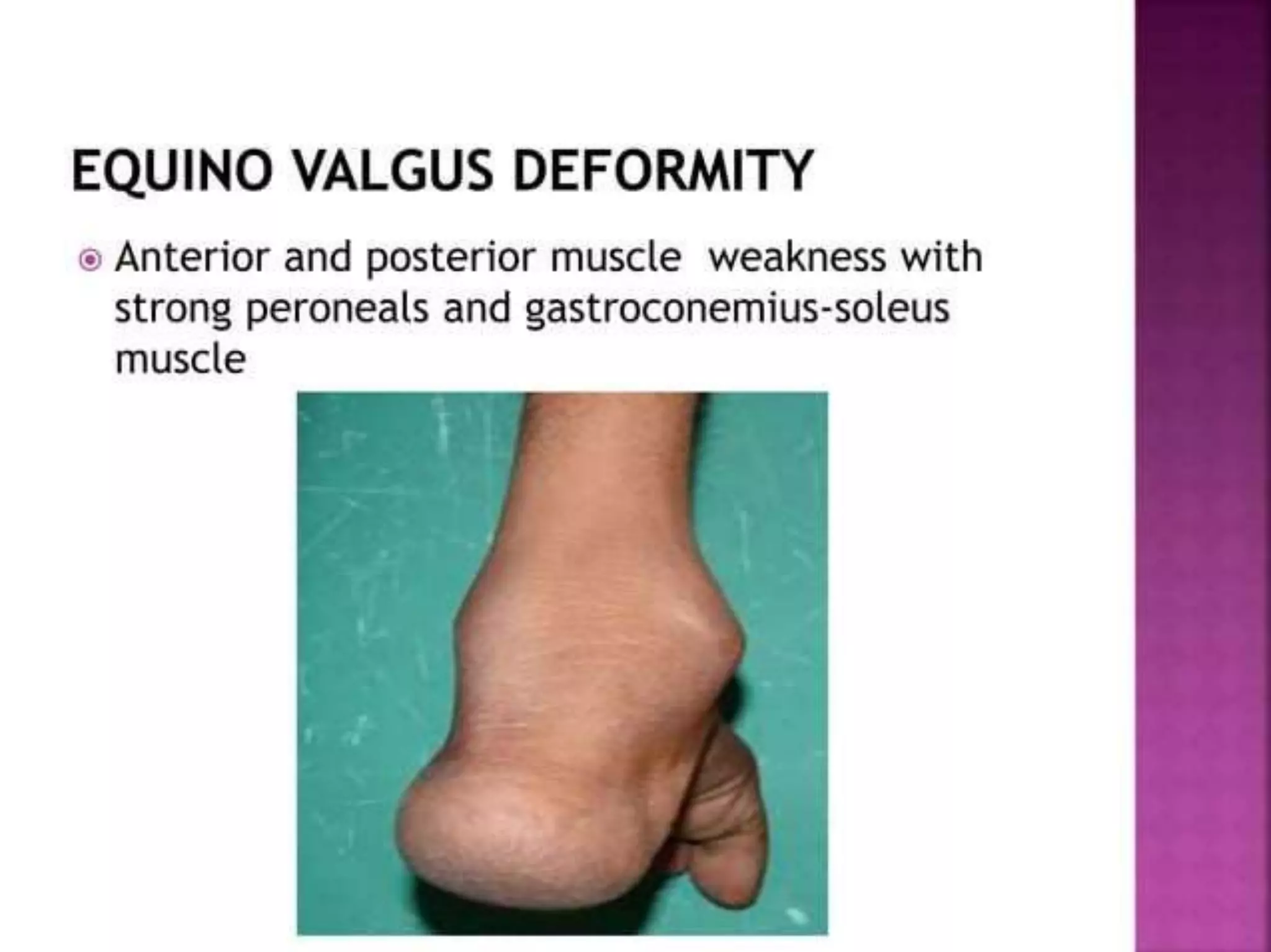 post polio residual paralysis.pptx