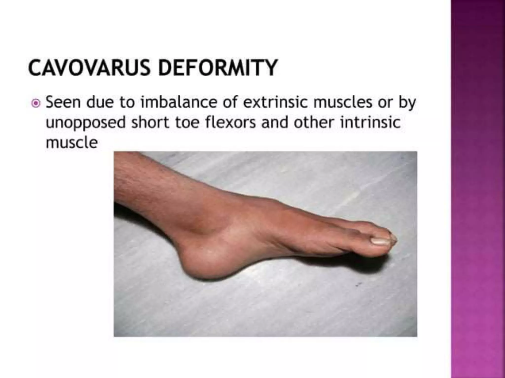 post polio residual paralysis.pptx