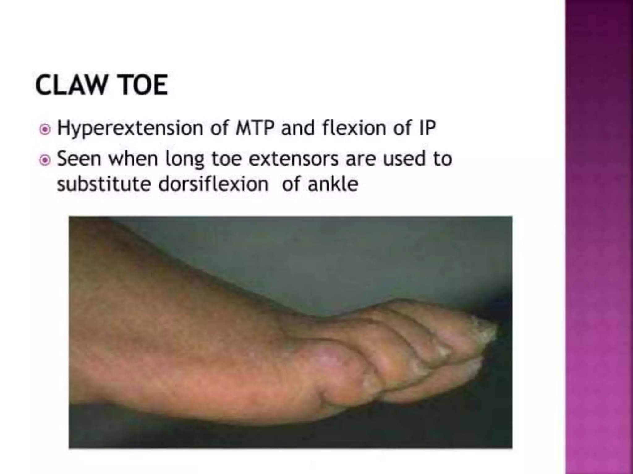 post polio residual paralysis.pptx