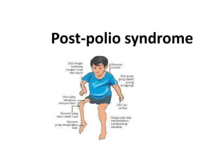 Post-polio syndrome
 