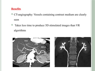 Benefits
 CT-angiography: Vessels containing contrast medium are clearly
seen
 Takes less time to produce 3D stimulated images than VR
algorithms
 