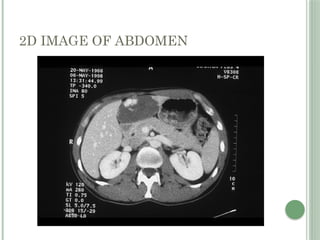 2D IMAGE OF ABDOMEN
 