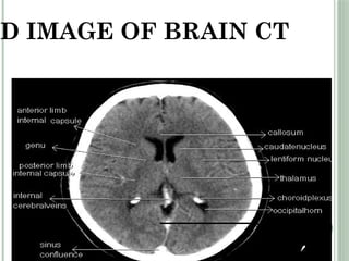 Straight Sinus
2D IMAGE OF BRAIN CT
 