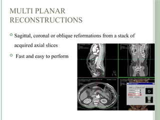 MULTI PLANAR
RECONSTRUCTIONS
 Sagittal, coronal or oblique reformations from a stack of
acquired axial slices
 Fast and easy to perform
 
