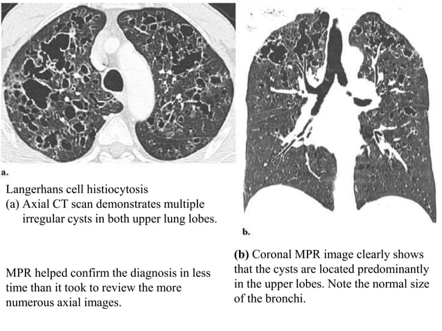 Post Processing of CT Thorax | PPTX