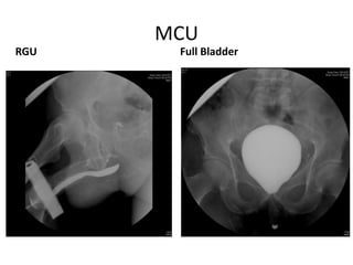 MCU
RGU Full Bladder
 