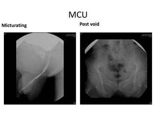 MCU
Micturating Post void
 