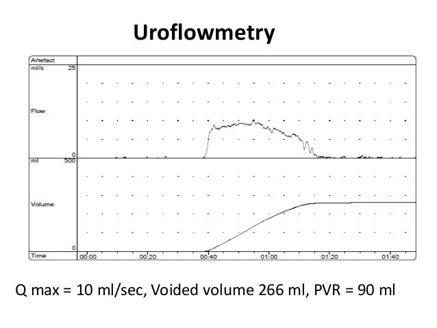 Post radical prostatectomy urinary incontinence