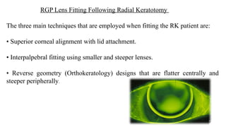 Post-Refractive Surgery Contact Lens Fitting Challenges and Solutions ...