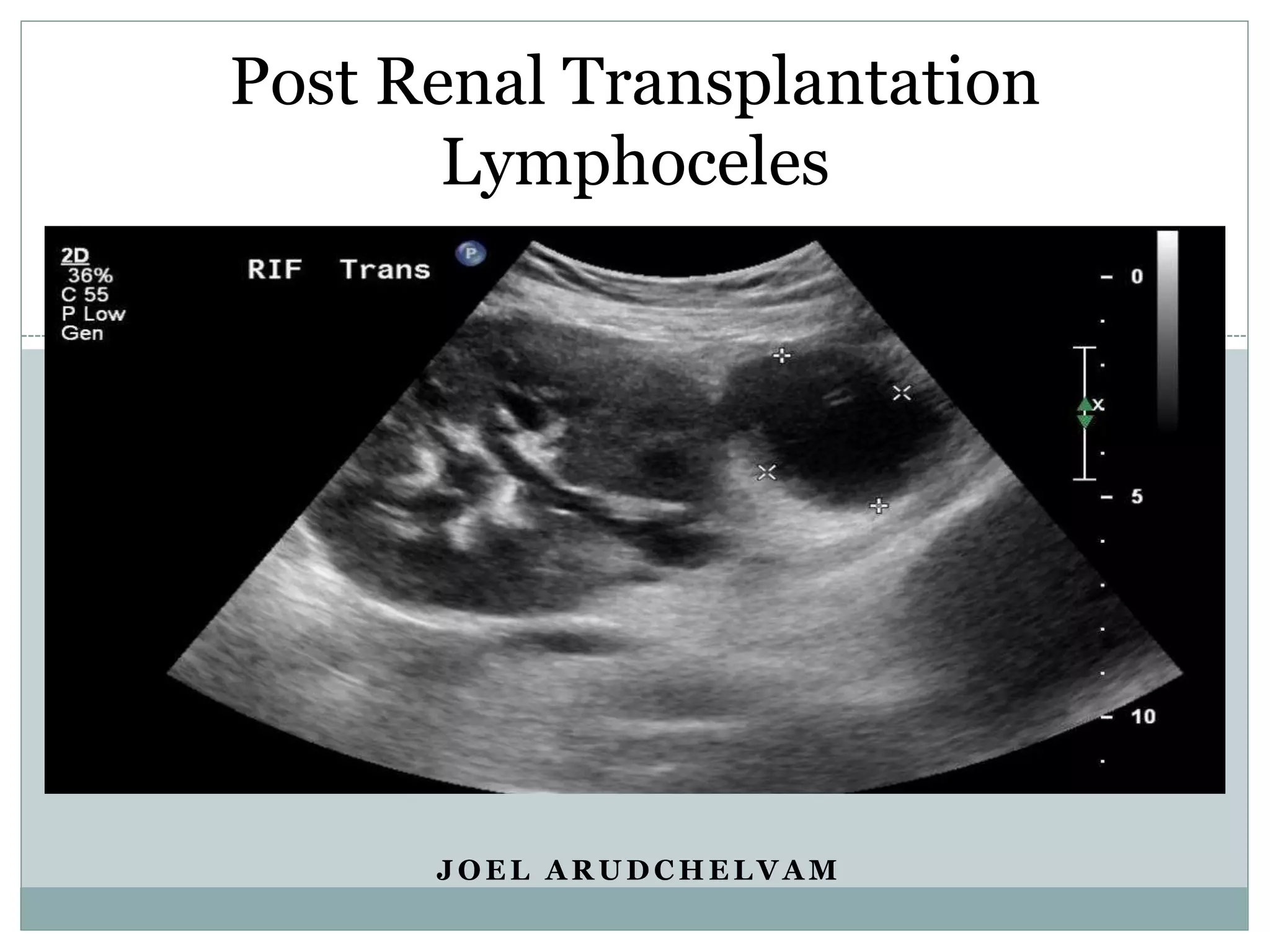 Post_Renal_Transplantation_lymphocele, Joel Arudchelvamceles.pptx