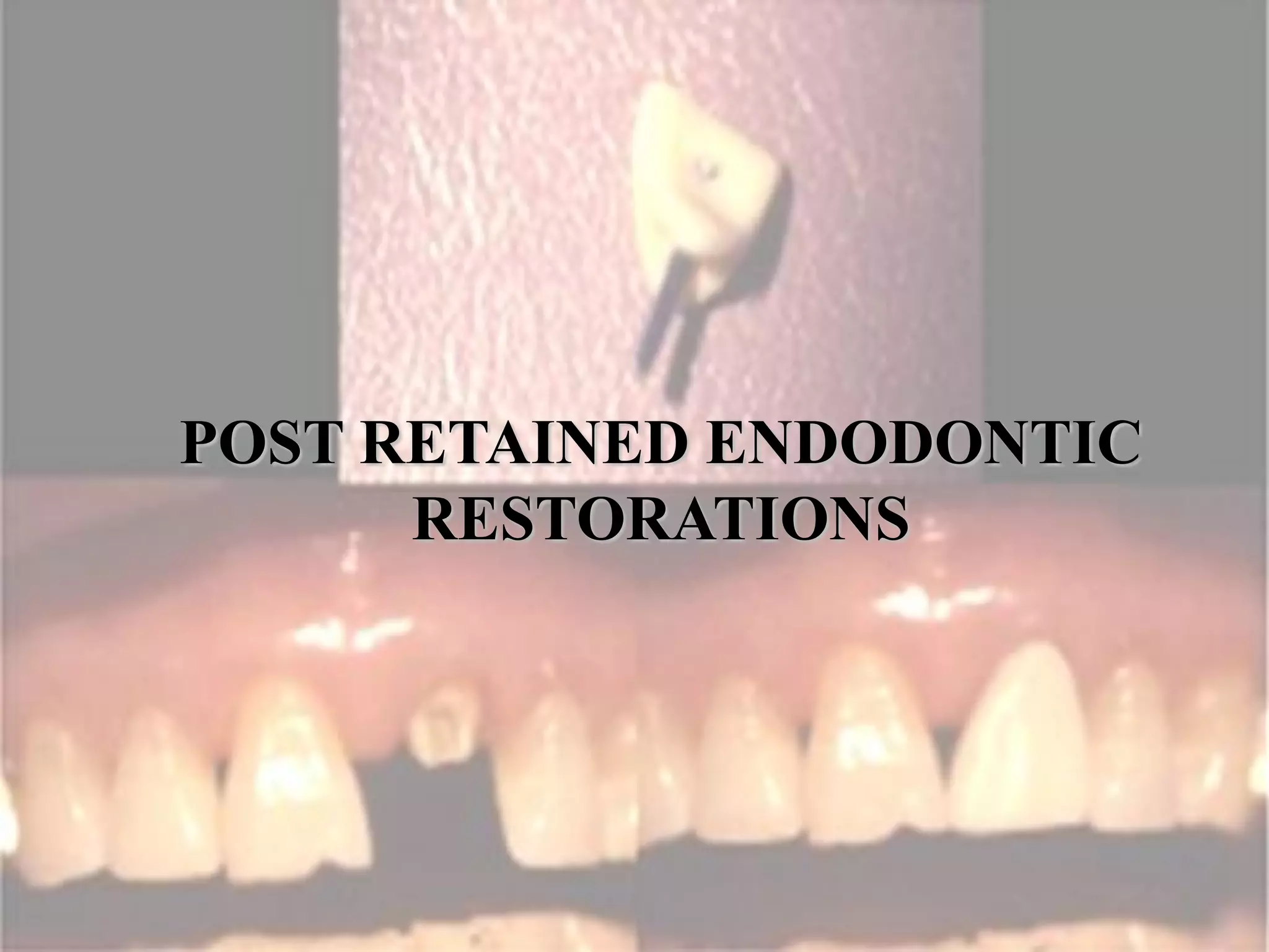 Post retained endodontic restorations PPT