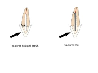 Post retained endodontic restorations | PDF
