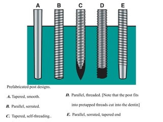 Post retained endodontic restorations | PDF