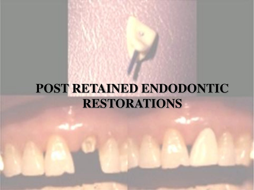 Post retained endodontic restorations