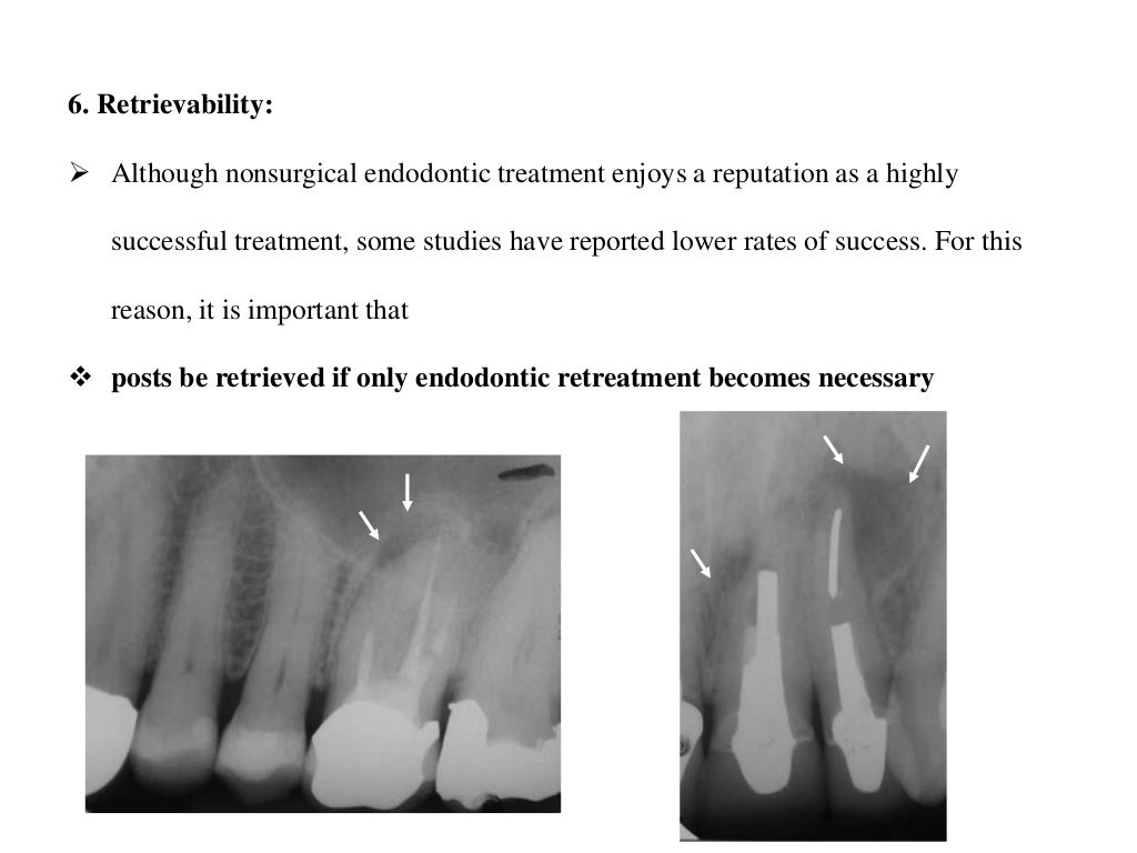 Post retained endodontic restorations