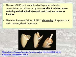 Decision Making in Restoration of Endodontically-Treated Teeth | PPTX