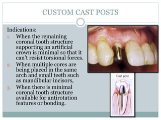 Comprehensive Guide to Post and Pins in Endodontic Restorations | PDF