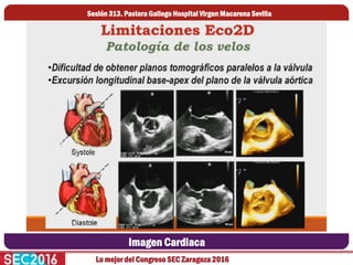 Lo mejor del Congreso SEC Zaragoza 2016
Imagen Cardiaca
Sesión 313. Pastora Gallego Hospital Virgen Macarena Sevilla
 
