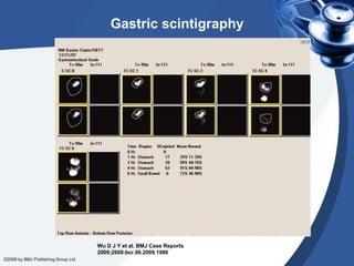 Gastric scintigraphy

Wu D J Y et al. BMJ Case Reports
2009;2009:bcr.06.2009.1986
©2009 by BMJ Publishing Group Ltd

 