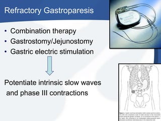 Refractory Gastroparesis
• Combination therapy
• Gastrostomy/Jejunostomy
• Gastric electric stimulation

Potentiate intrinsic slow waves
and phase III contractions

 