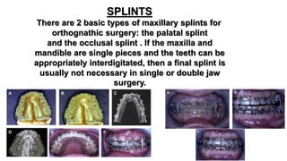 Postsurgical orthodontics | PPTX