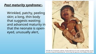 Post maturity syndrome:-
Wrinkled, patchy, peeling
skin; a long, thin body
that suggests wasting;
and advanced maturity in
that the neonate is open-
eyed, unusually alert,
 