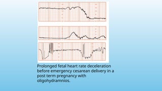 Prolonged fetal heart rate deceleration
before emergency cesarean delivery in a
post term pregnancy with
oligohydramnios.
 
