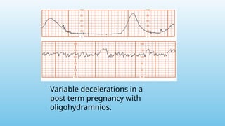 Variable decelerations in a
post term pregnancy with
oligohydramnios.
 