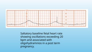 Saltatory baseline fetal heart rate
showing oscillations exceeding 20
bpm and associated with
oligohydramnios in a post term
pregnancy.
 