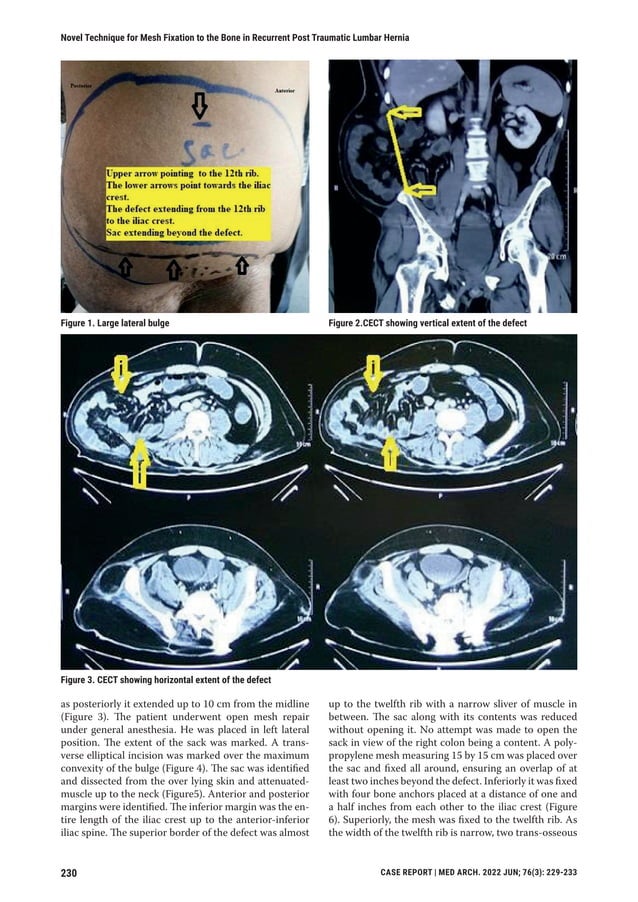 Novel Technique for Mesh Fixation to the Bone in Recurrent Post Traumatic Lumbar Hernia