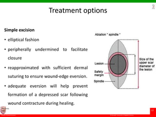 © Ramaiah University of Applied Sciences
12
Faculty of Dental Sciences
University
Logo
Treatment options
Simple excision
• elliptical fashion
• peripherally undermined to facilitate
closure
• reapproximated with sufficient dermal
suturing to ensure wound-edge eversion.
• adequate eversion will help prevent
formation of a depressed scar following
wound contracture during healing.
 