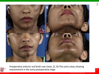 © Ramaiah University of Applied Sciences
14
Faculty of Dental Sciences
University
Logo
Preoperative anterior and bird’s-eye views. (C, D) The same views showing
improvement in the early postoperative stage
 
