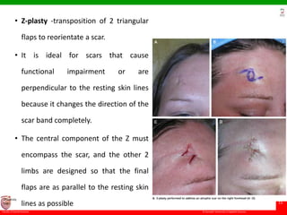 © Ramaiah University of Applied Sciences
15
Faculty of Dental Sciences
University
Logo
• Z-plasty -transposition of 2 triangular
flaps to reorientate a scar.
• It is ideal for scars that cause
functional impairment or are
perpendicular to the resting skin lines
because it changes the direction of the
scar band completely.
• The central component of the Z must
encompass the scar, and the other 2
limbs are designed so that the final
flaps are as parallel to the resting skin
lines as possible
 
