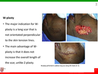 © Ramaiah University of Applied Sciences
16
Faculty of Dental Sciences
University
Logo
W-plasty
• The major indication for W-
plasty is a long scar that is
not orientated perpendicular
to the skin tension lines.
• The main advantage of W-
plasty is that it does not
increase the overall length of
the scar, unlike Z-plasty.
 