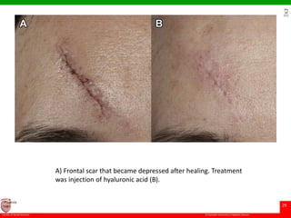 © Ramaiah University of Applied Sciences
29
Faculty of Dental Sciences
University
Logo
A) Frontal scar that became depressed after healing. Treatment
was injection of hyaluronic acid (B).
 
