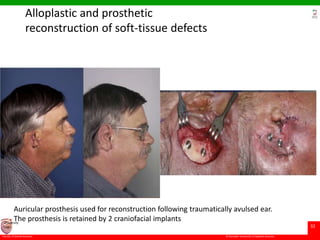 © Ramaiah University of Applied Sciences
32
Faculty of Dental Sciences
University
Logo
Alloplastic and prosthetic
reconstruction of soft-tissue defects
Auricular prosthesis used for reconstruction following traumatically avulsed ear.
The prosthesis is retained by 2 craniofacial implants
 