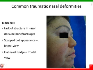 © Ramaiah University of Applied Sciences
37
Faculty of Dental Sciences
University
Logo
Common traumatic nasal deformities
Saddle nose
• Lack of structure in nasal
dorsum (bone/cartilage)
• Scooped out appearance –
lateral view
• Flat nasal bridge – frontal
view
 