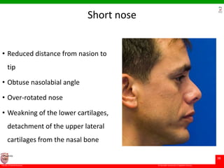 © Ramaiah University of Applied Sciences
38
Faculty of Dental Sciences
University
Logo
Short nose
• Reduced distance from nasion to
tip
• Obtuse nasolabial angle
• Over-rotated nose
• Weakning of the lower cartilages,
detachment of the upper lateral
cartilages from the nasal bone
 