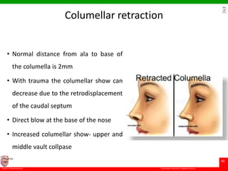 © Ramaiah University of Applied Sciences
40
Faculty of Dental Sciences
University
Logo
Columellar retraction
• Normal distance from ala to base of
the columella is 2mm
• With trauma the columellar show can
decrease due to the retrodisplacement
of the caudal septum
• Direct blow at the base of the nose
• Increased columellar show- upper and
middle vault collpase
 
