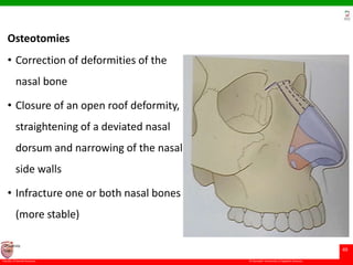 © Ramaiah University of Applied Sciences
49
Faculty of Dental Sciences
University
Logo
Osteotomies
• Correction of deformities of the
nasal bone
• Closure of an open roof deformity,
straightening of a deviated nasal
dorsum and narrowing of the nasal
side walls
• Infracture one or both nasal bones
(more stable)
 