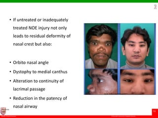 © Ramaiah University of Applied Sciences
51
Faculty of Dental Sciences
University
Logo
• If untreated or inadequately
treated NOE injury not only
leads to residual deformity of
nasal crest but also:
• Orbito nasal angle
• Dystophy to medial canthus
• Alteration to continuity of
lacrimal passage
• Reduction in the patency of
nasal airway
 