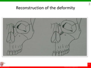 © Ramaiah University of Applied Sciences
52
Faculty of Dental Sciences
University
Logo
Reconstruction of the deformity
 