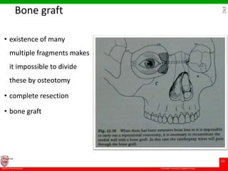 © Ramaiah University of Applied Sciences
53
Faculty of Dental Sciences
University
Logo
Bone graft
• existence of many
multiple fragments makes
it impossible to divide
these by osteotomy
• complete resection
• bone graft
 