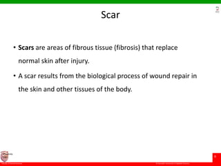 © Ramaiah University of Applied Sciences
6
Faculty of Dental Sciences
University
Logo
Scar
• Scars are areas of fibrous tissue (fibrosis) that replace
normal skin after injury.
• A scar results from the biological process of wound repair in
the skin and other tissues of the body.
 