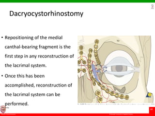 © Ramaiah University of Applied Sciences
60
Faculty of Dental Sciences
University
Logo
Dacryocystorhinostomy
• Repositioning of the medial
canthal-bearing fragment is the
first step in any reconstruction of
the lacrimal system.
• Once this has been
accomplished, reconstruction of
the lacrimal system can be
performed.
 