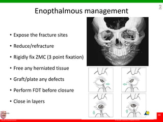 © Ramaiah University of Applied Sciences
68
Faculty of Dental Sciences
University
Logo
Enopthalmous management
• Expose the fracture sites
• Reduce/refracture
• Rigidly fix ZMC (3 point fixation)
• Free any herniated tissue
• Graft/plate any defects
• Perform FDT before closure
• Close in layers
 