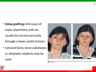 © Ramaiah University of Applied Sciences
72
Faculty of Dental Sciences
University
Logo
• Onlay grafting-mild cases of
malar asymmetry and can
usually be carried out easily
through a lower eyelid incision.
• Calvarial bone, bone substitutes
or alloplastic implants may be
used
 