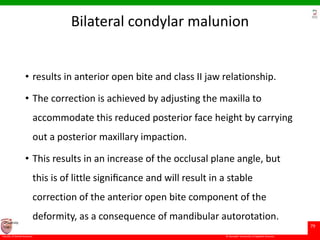 © Ramaiah University of Applied Sciences
79
Faculty of Dental Sciences
University
Logo
Bilateral condylar malunion
• results in anterior open bite and class II jaw relationship.
• The correction is achieved by adjusting the maxilla to
accommodate this reduced posterior face height by carrying
out a posterior maxillary impaction.
• This results in an increase of the occlusal plane angle, but
this is of little signiﬁcance and will result in a stable
correction of the anterior open bite component of the
deformity, as a consequence of mandibular autorotation.
 