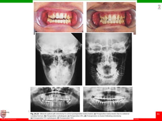 © Ramaiah University of Applied Sciences
81
Faculty of Dental Sciences
University
Logo
 